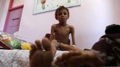 انتشار سوء التغذية في اليمن